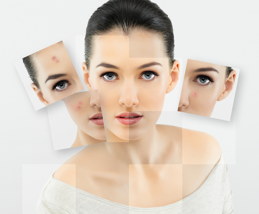 The main side effects of full-face hyaluronic acid injecting you should know